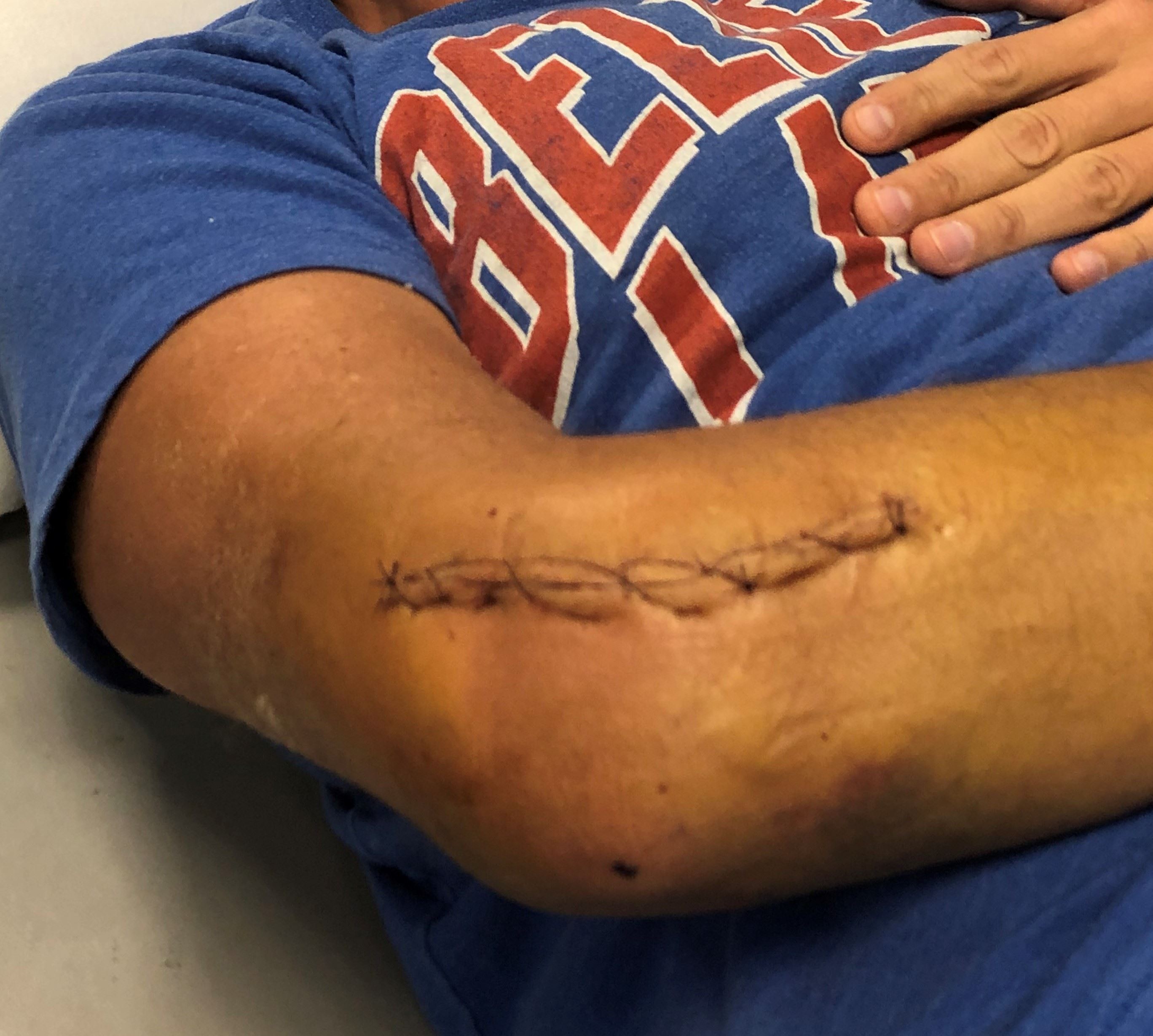 Right elbow of injured person with stitches